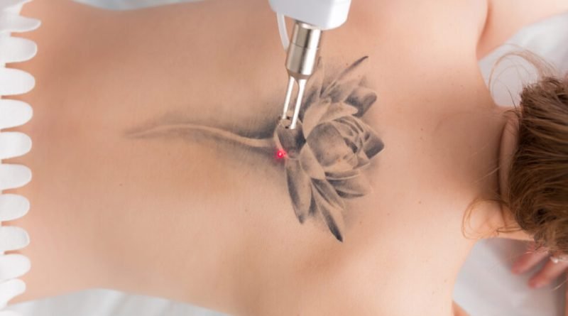 Remoção de tatuagens cresce e evolui suas técnicas