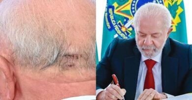 Lula vai passar por novo procedimento médico para impedir sangramentos no cérebro