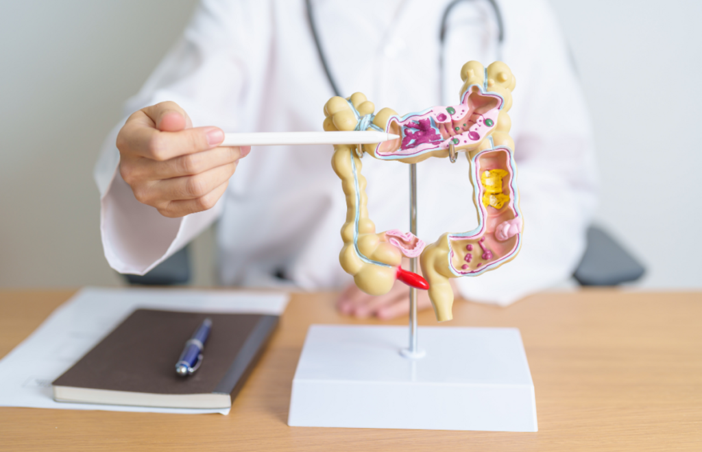 Com diagnóstico precoce, câncer colorretal tem 90% de cura