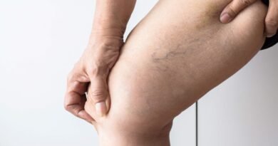 Tratamento de varizes evolui com métodos menos invasivos