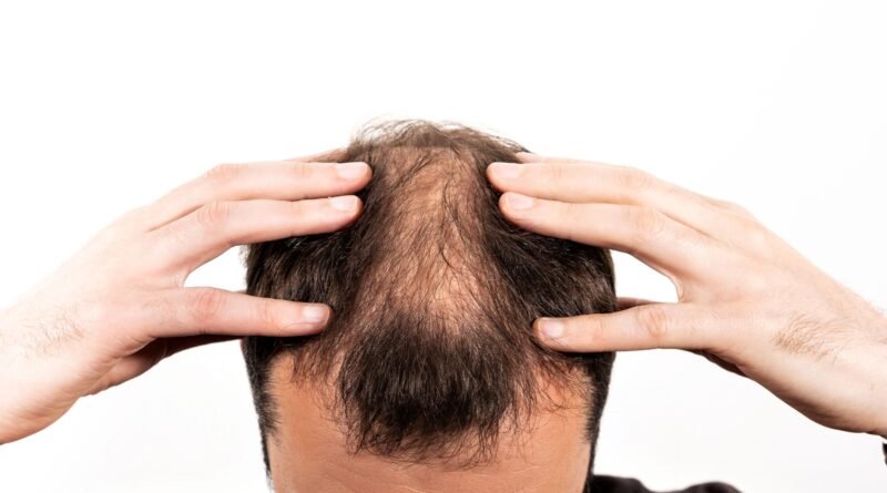 Alopecia: técnicas de tricologia podem oferecer soluções