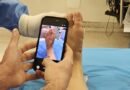 Tratamento das joanetes avança com cirurgia pouco invasiva