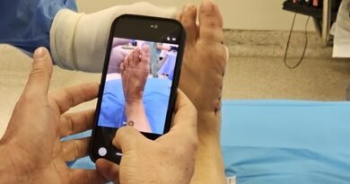 Tratamento das joanetes avança com cirurgia pouco invasiva