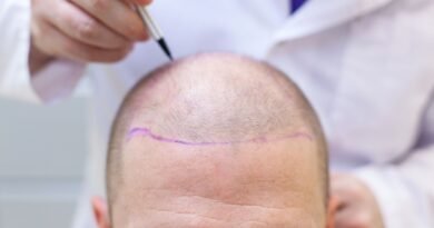 Revisão de transplante capilar exige especialização