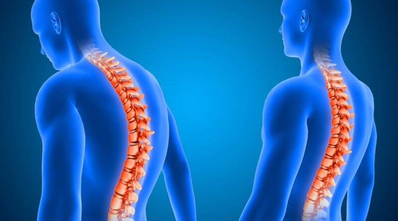Cirurgia de escoliose é a 1ª com neuronavegação em Uberlândia