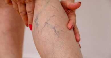 Obesidade e varizes têm relação e exigem atenção médica