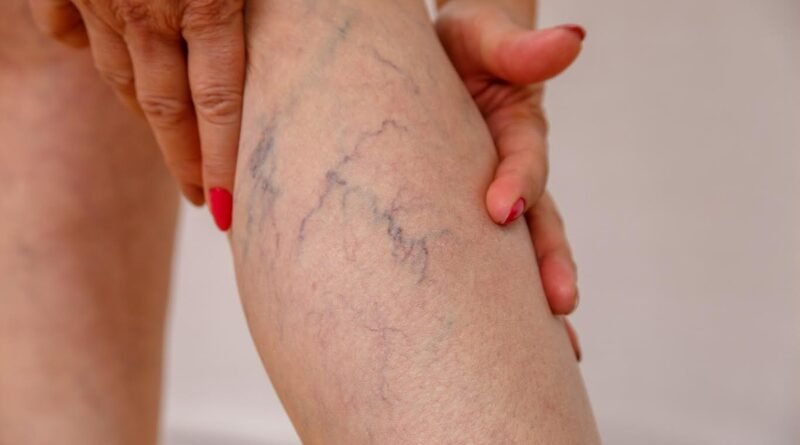 Obesidade e varizes têm relação e exigem atenção médica