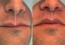 Lip Lift amplia opções de rejuvenescimento sem volume