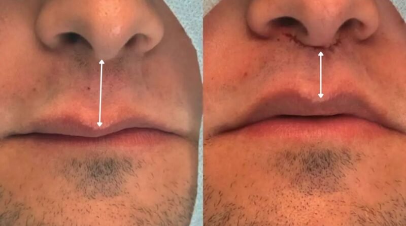 Lip Lift amplia opções de rejuvenescimento sem volume