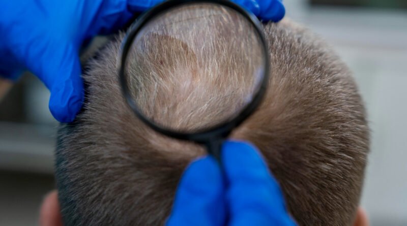 Tricologia ganha espaço no cuidado com a queda capilar