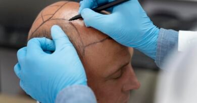 Técnica FUE redefine padrões de transplante capilar moderno