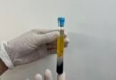 CFM regulamenta PRP em condições osteomusculares