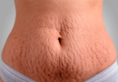 Cirurgia plástica e estética se aliam contra as estrias