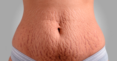 Cirurgia plástica e estética se aliam contra as estrias