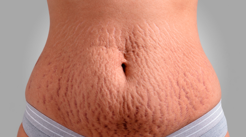 Cirurgia plástica e estética se aliam contra as estrias