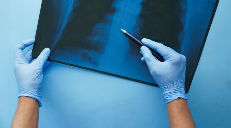 CONITEC abre consulta para Hipertensão Arterial Pulmonar