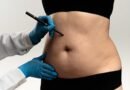 Lipoaspiração lidera preferência por cirurgias plásticas
