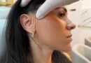 Lifting facial endoscópico dispensa cicatriz visível