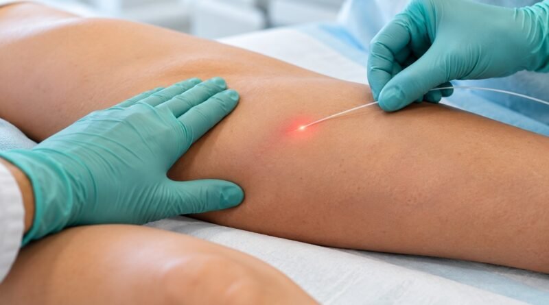 Laser permite tratar a safena sem retirar a veia da perna