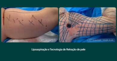 Tratamento remove flacidez do braço com tecnologia associada