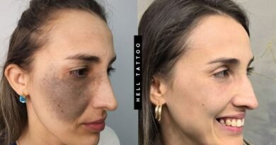 Nevo de Ota pode ser tratado com laser, explica biomédico