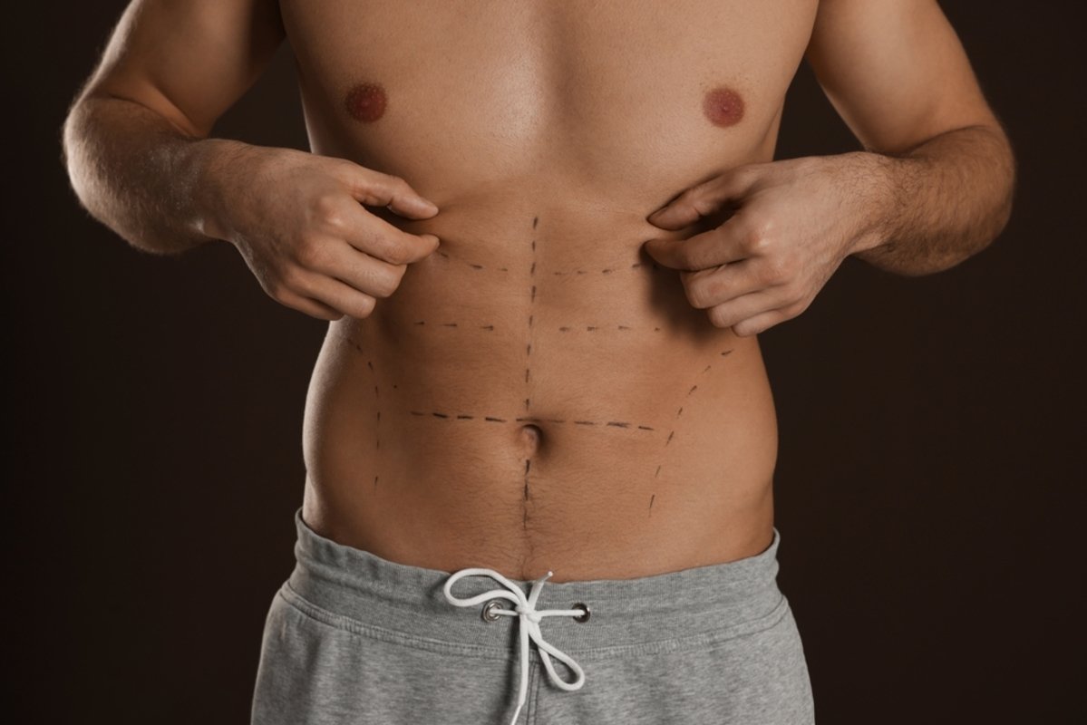 Definição em foco: a evolução da lipoaspiração masculina