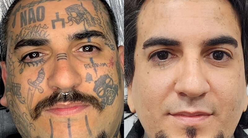 Remoção de tatuagem cresce e muda perfil de quem procura